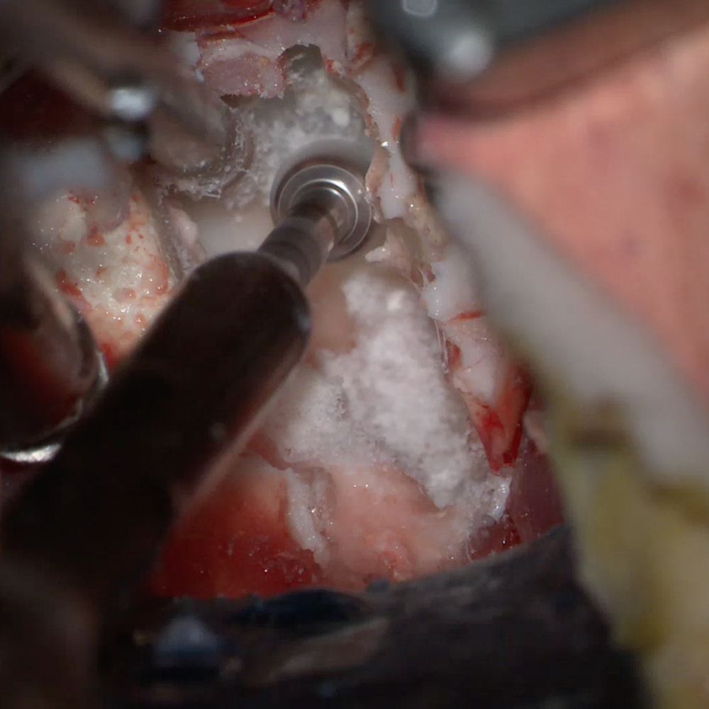 Anterior Cervical Box
