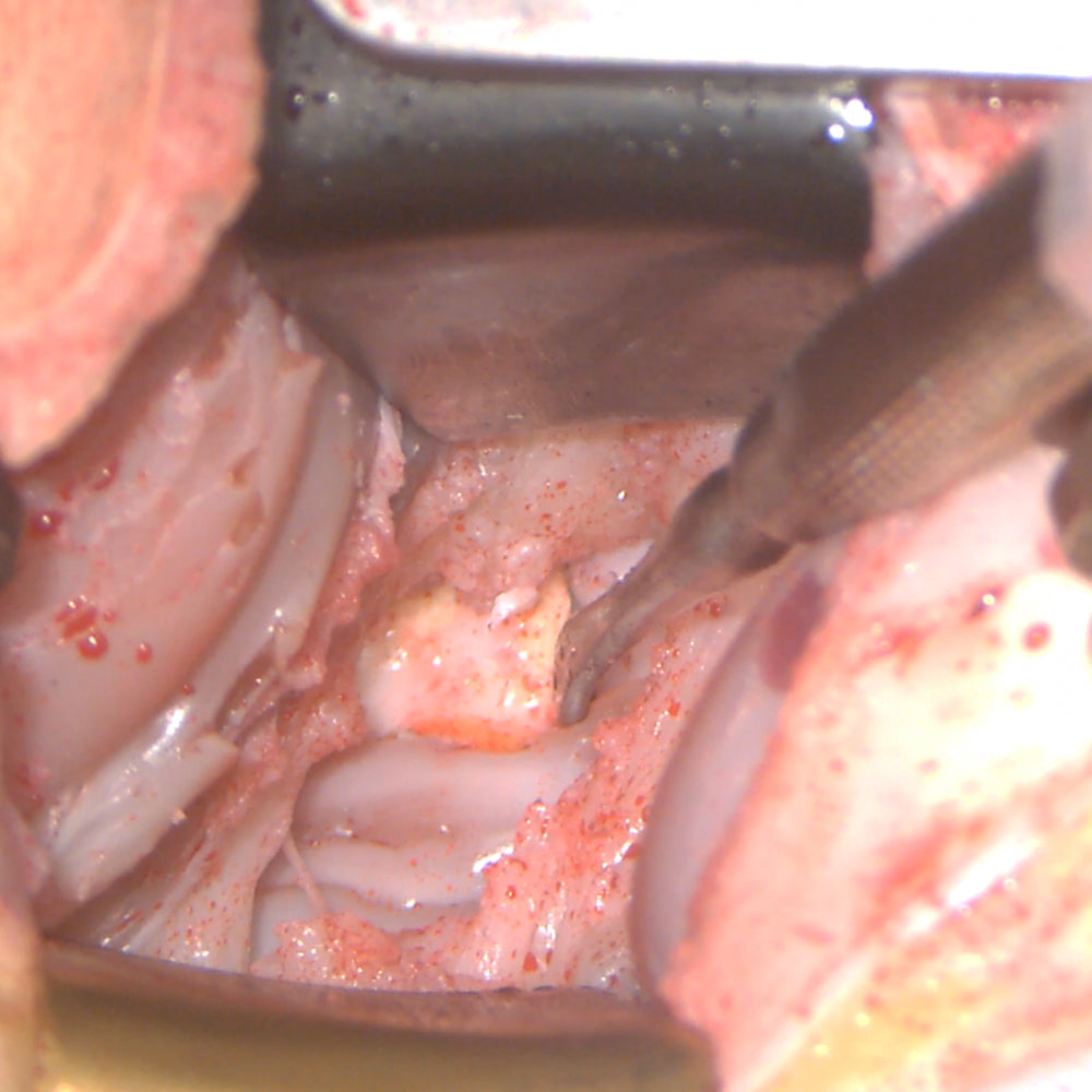 Anterior Cervical Box