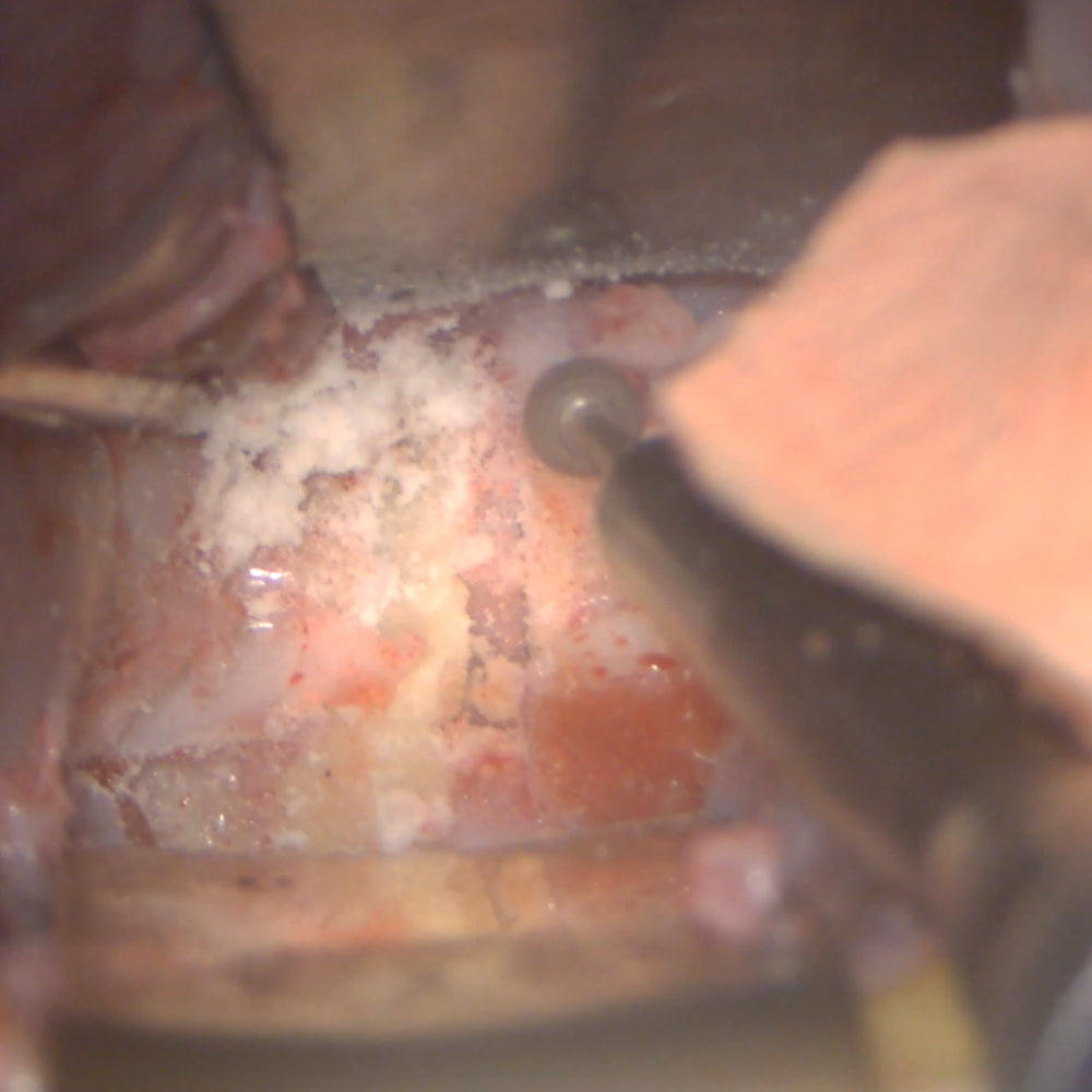 Anterior Cervical Box