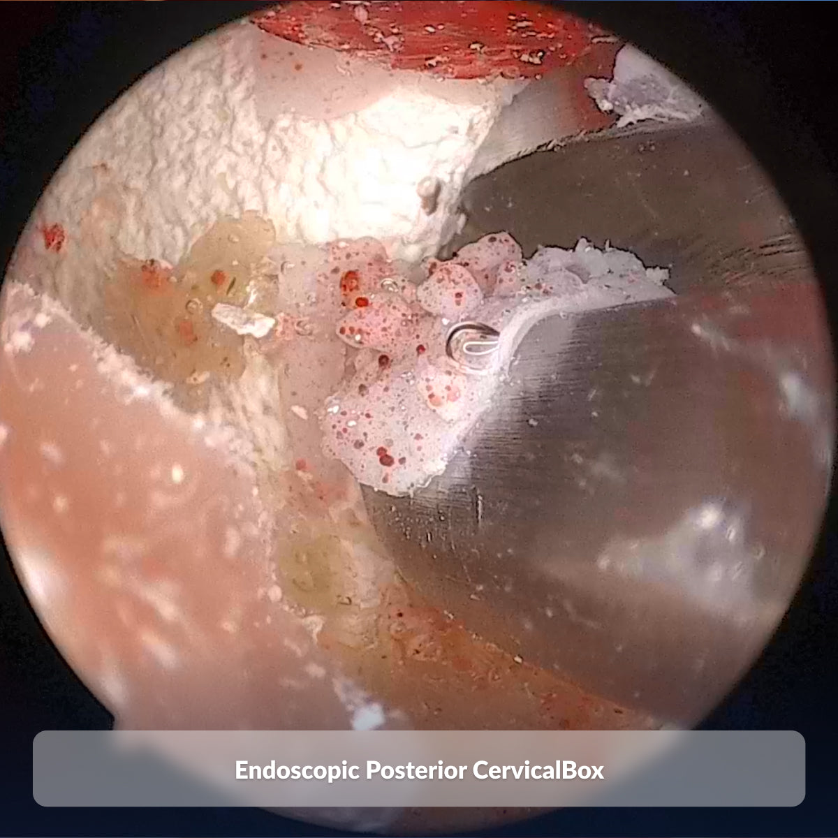 Endoscopic Posterior CervicalBox