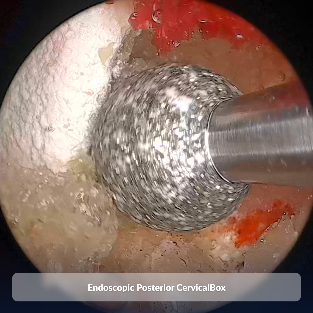 Endoscopic Posterior CervicalBox