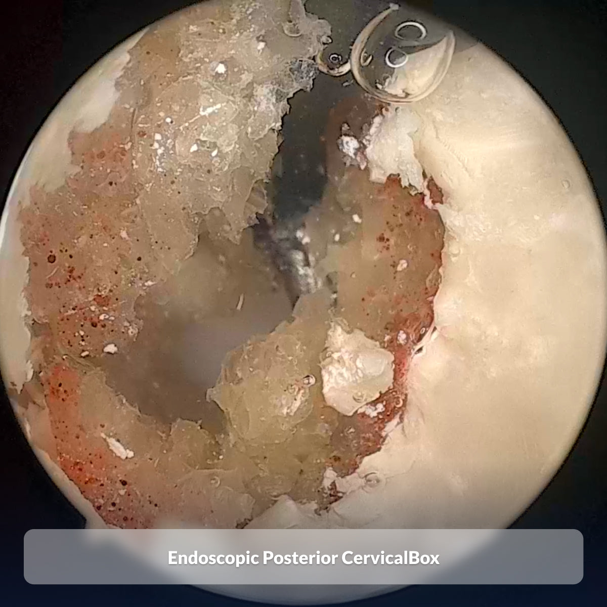 Endoscopic Posterior CervicalBox