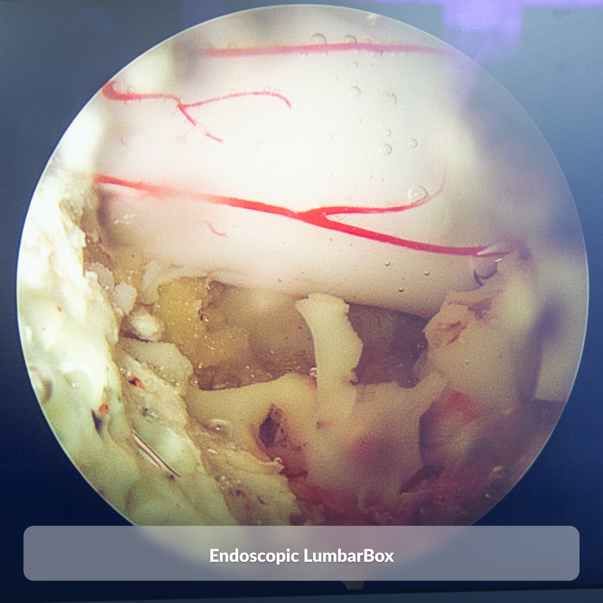 Endoscopic LumbarBox
