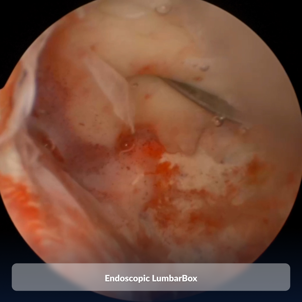 Endoscopic LumbarBox