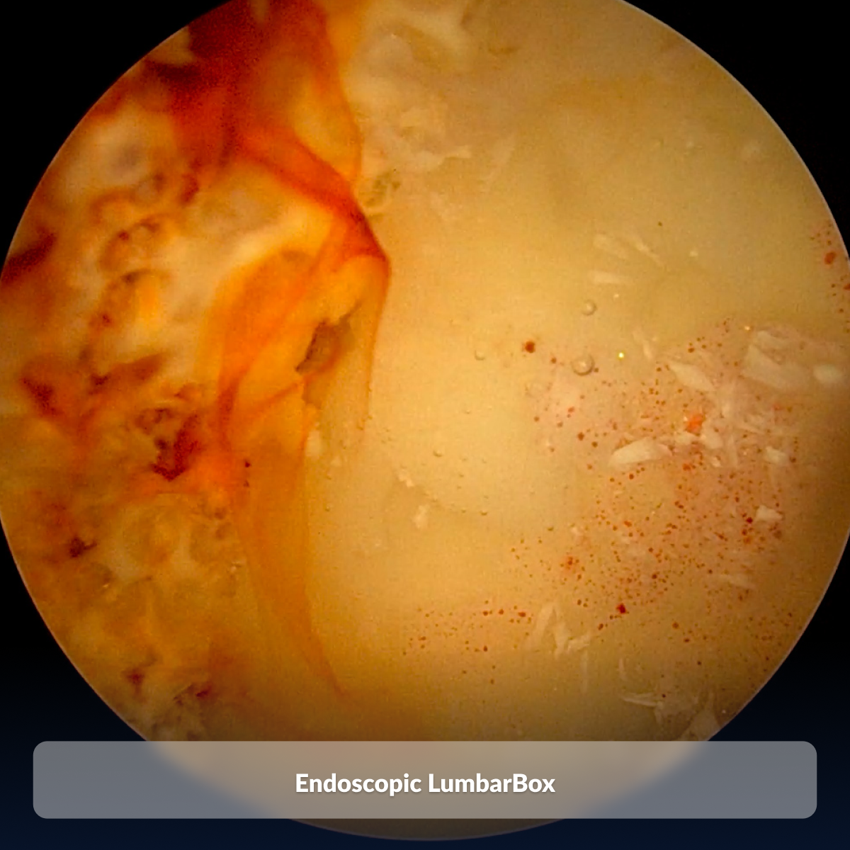Endoscopic LumbarBox