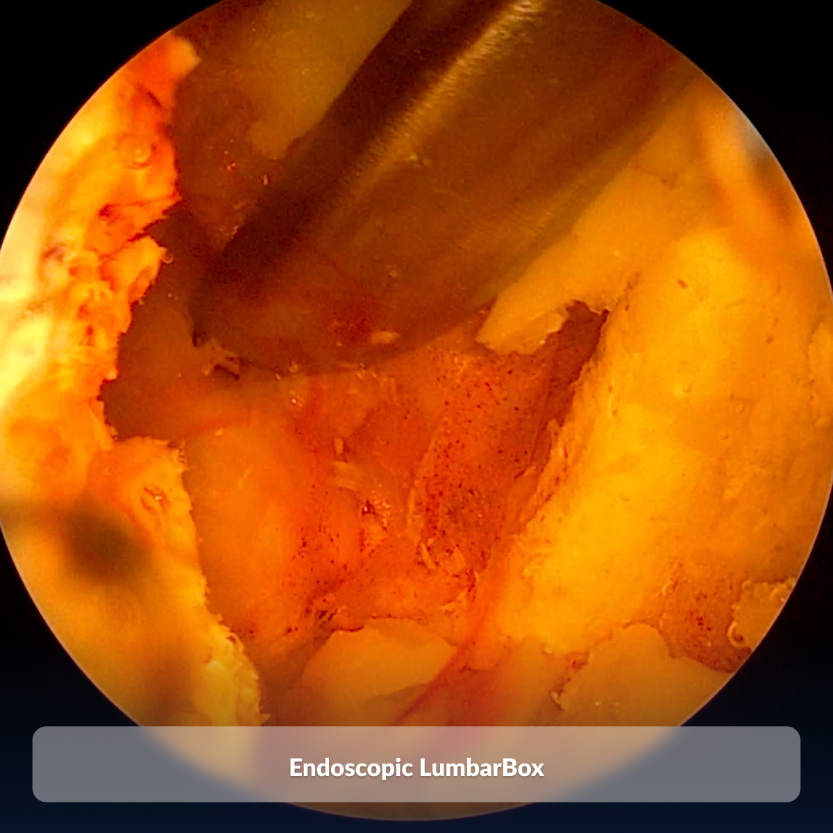 Endoscopic LumbarBox