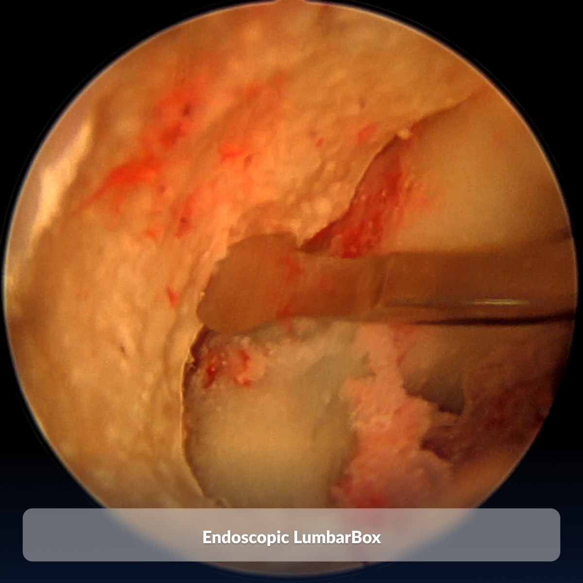 Endoscopic LumbarBox