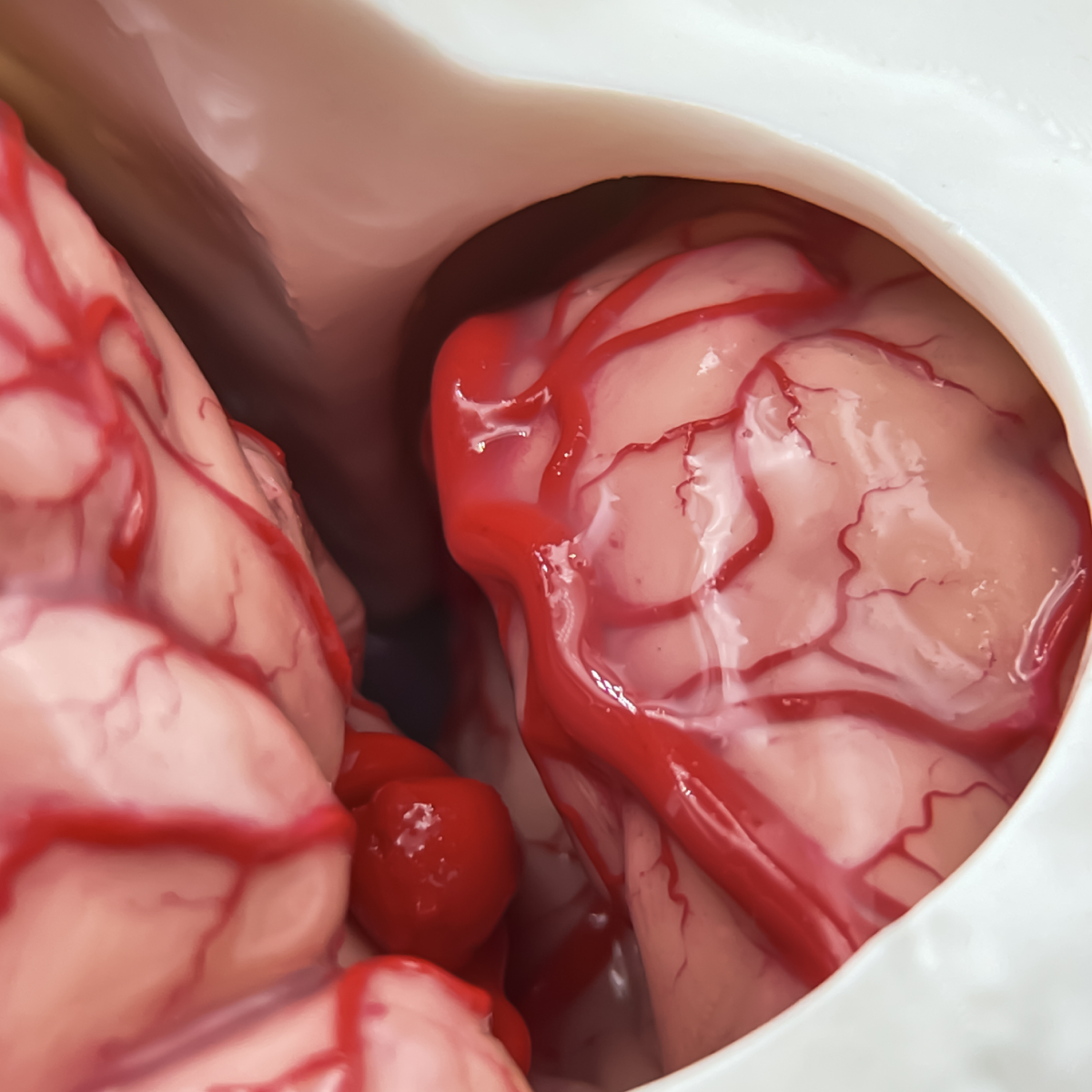 AneurysmBox