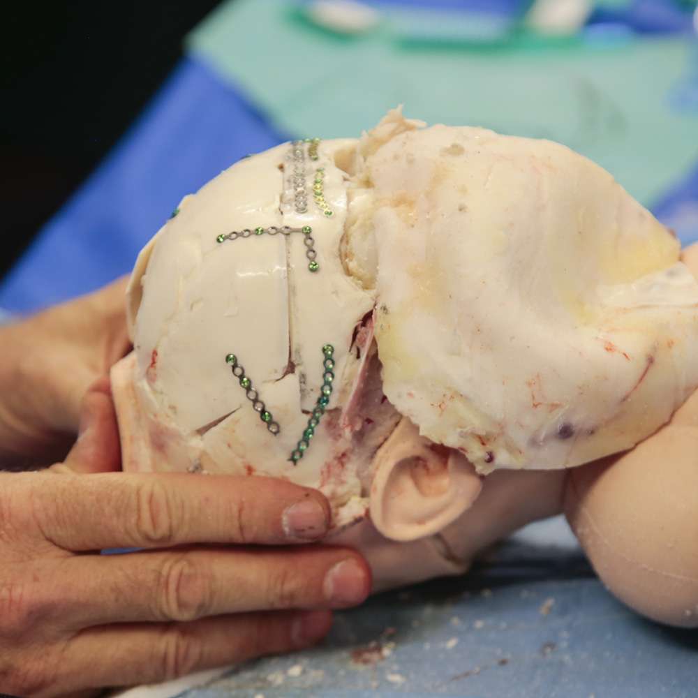 Paediatric Craniosynostosis