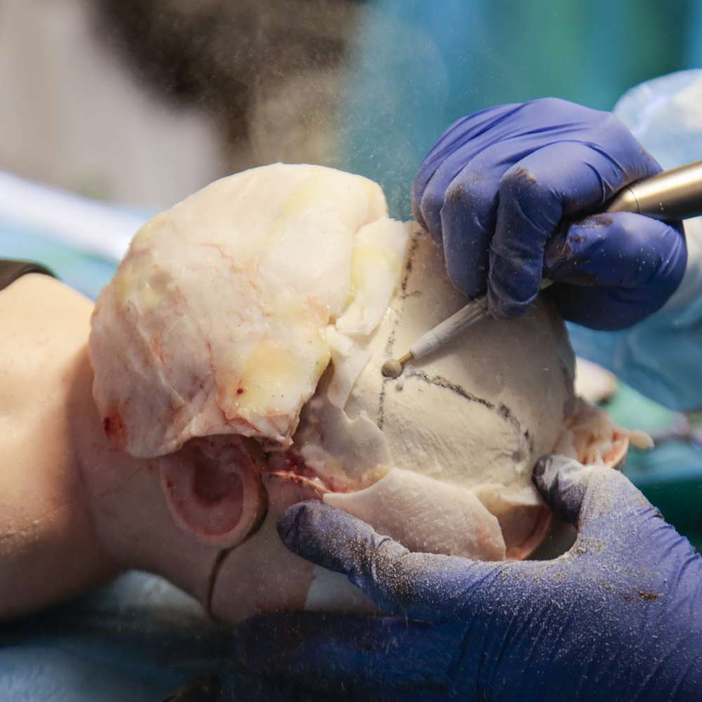 Paediatric Craniosynostosis