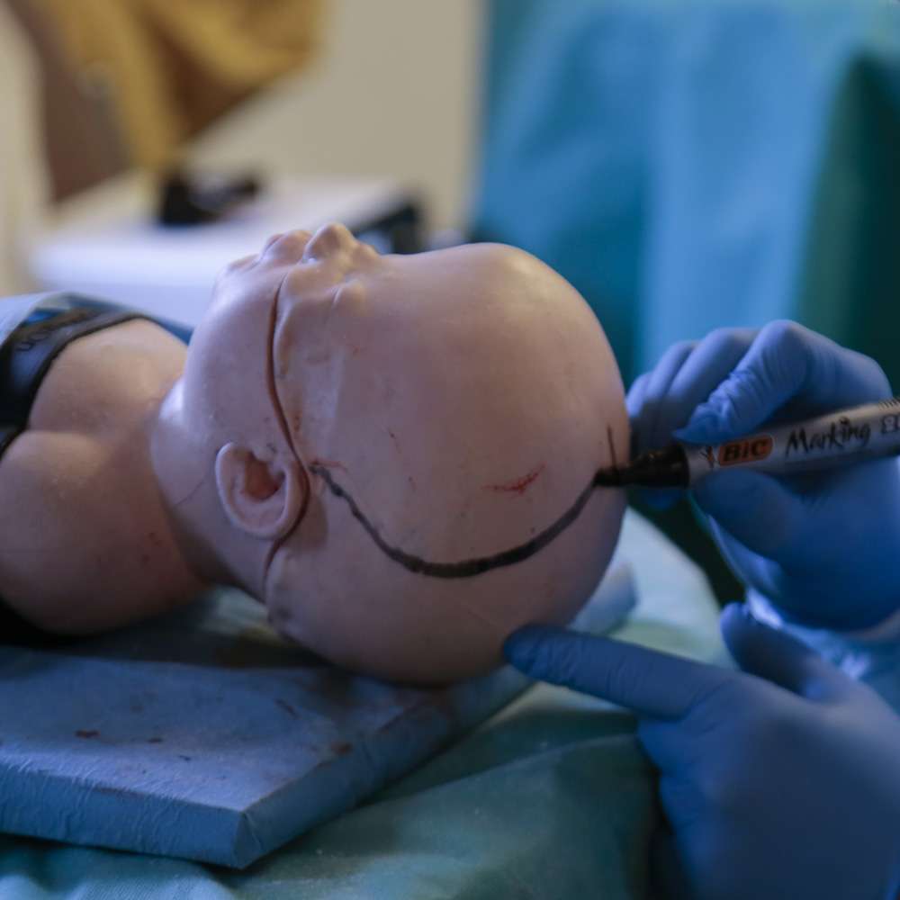 Paediatric Craniosynostosis