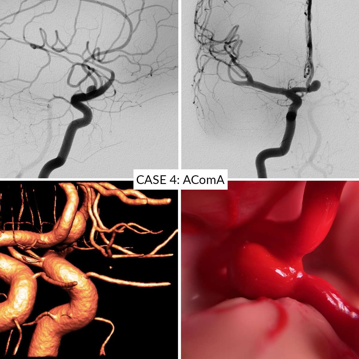 Aneurysm Training Kit