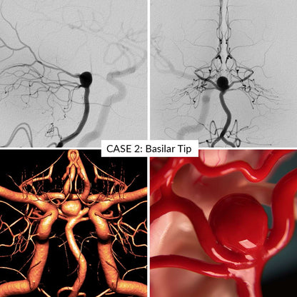 Aneurysm Training Kit