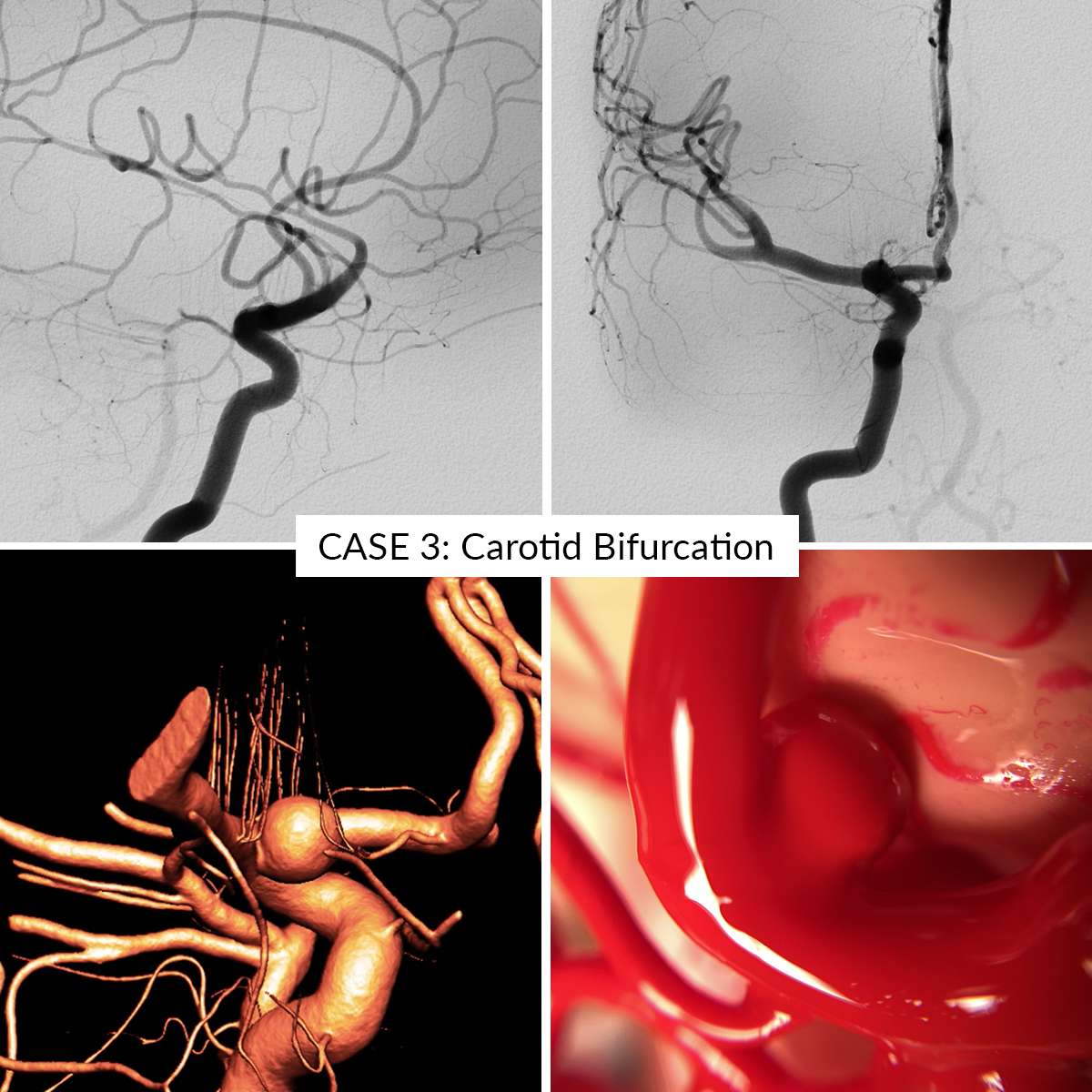 Aneurysm Training Kit