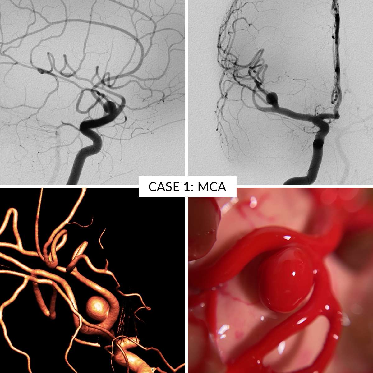 Aneurysm Training Kit