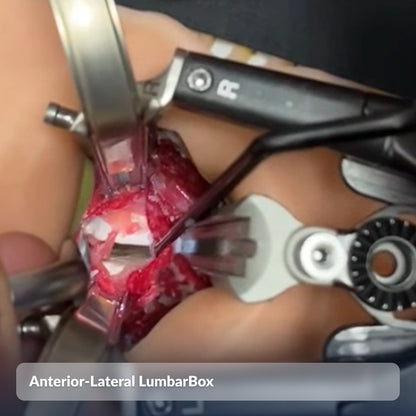 Anterior-Lateral LumbarBox
