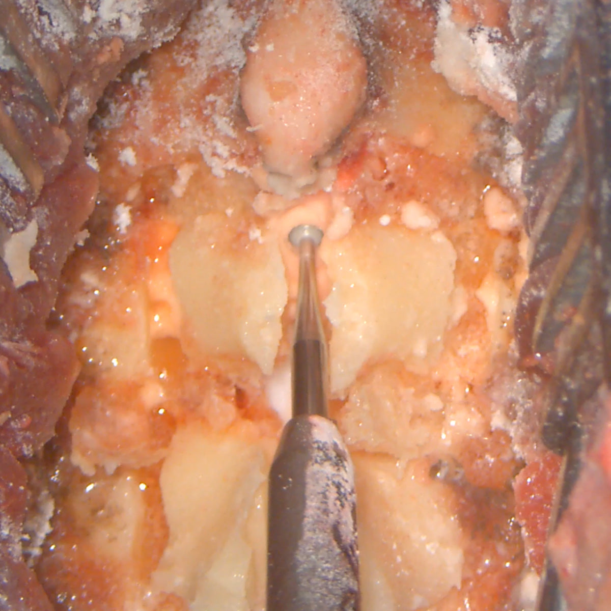 Posterior Cervical Box